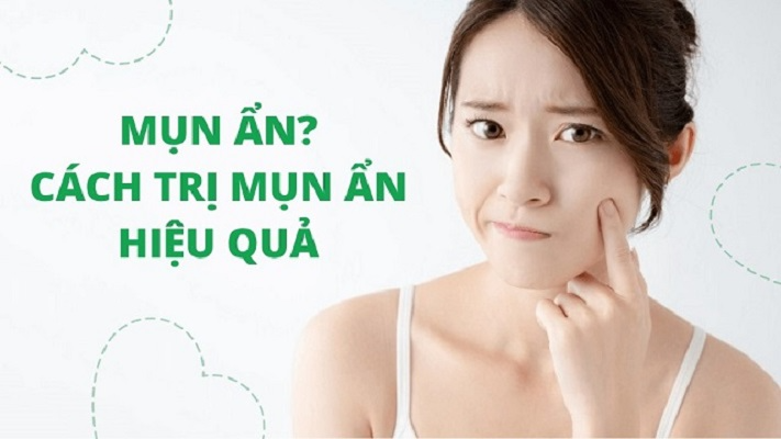 Cách chăm sóc da mặt bị mụn ẩn tại nhà đơn giản và an toàn