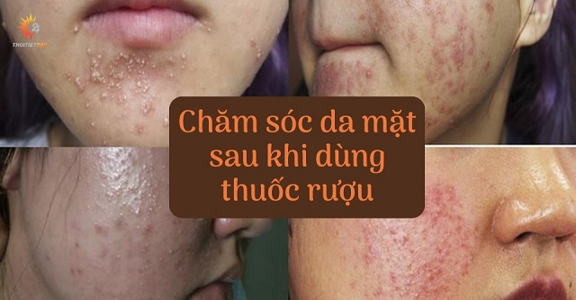 Cách chăm sóc da mặt sau khi dùng thuốc rượu phục hồi nhanh  