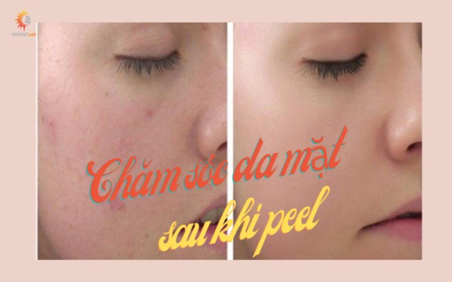 Tuyệt chiêu chăm sóc da mặt sau peel phục hồi nhanh, an toàn