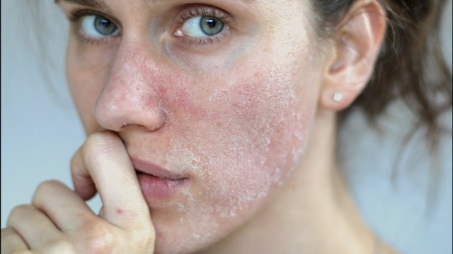  Da khô, sần sùi là biểu hiện của da mặt bị lão hóa 