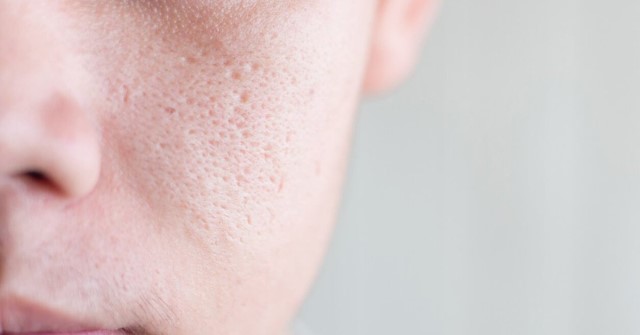  Lỗ chân lông to là biểu hiện của da mặt bị lão hóa 