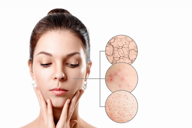 Làn da hỗn hợp thường tập trung nhiều khuyết điểm trên mặt
