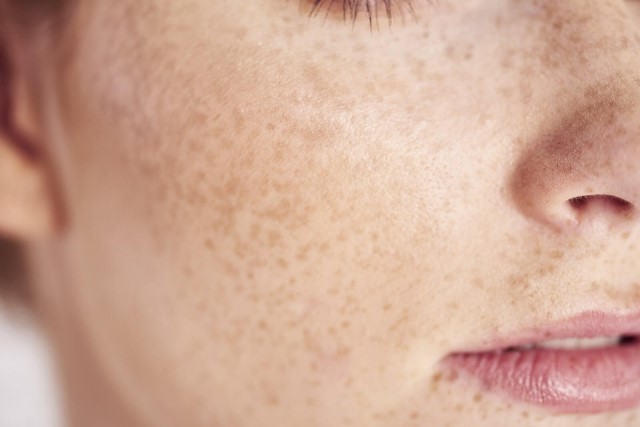  Cách chăm sóc da mặt bị tàn nhang bằng vitamin C 