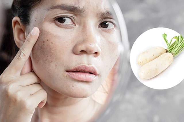  Cách chăm sóc da mặt bị tàn nhang từ củ cải trắng