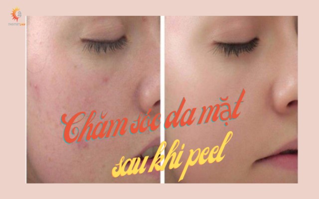   Cách chăm sóc da mặt sau peel đạt hiệu quả tốt